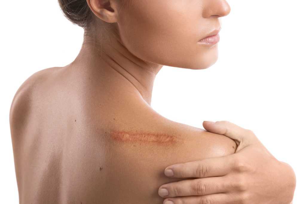 Comment éviter l’apparition d’une cicatrice hypertrophique ?