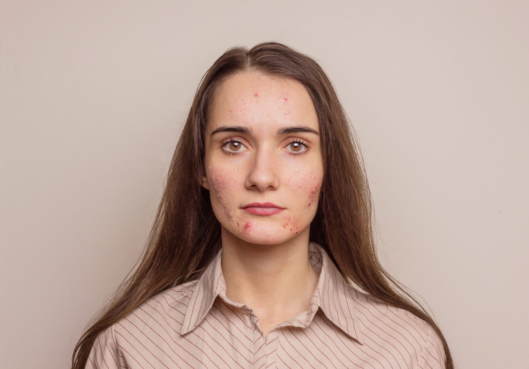 Acné kystique : causes, conséquences et traitement