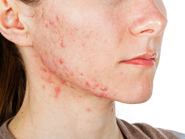 Quel est le meilleur traitement pour l’acné hormonale ?