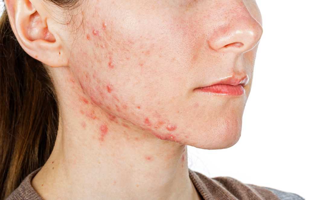 Quel est le meilleur traitement pour l’acné hormonale ?