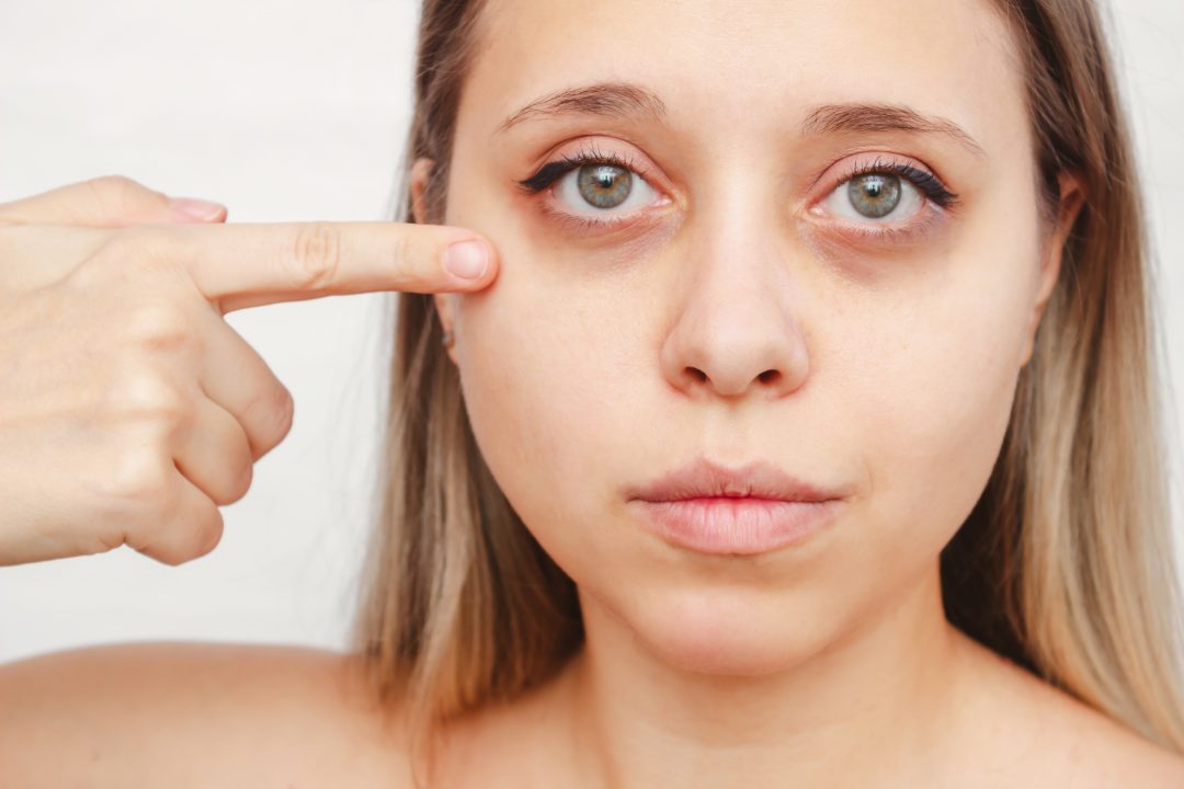 Poches sous les yeux votre foie essaie de vous alerter...