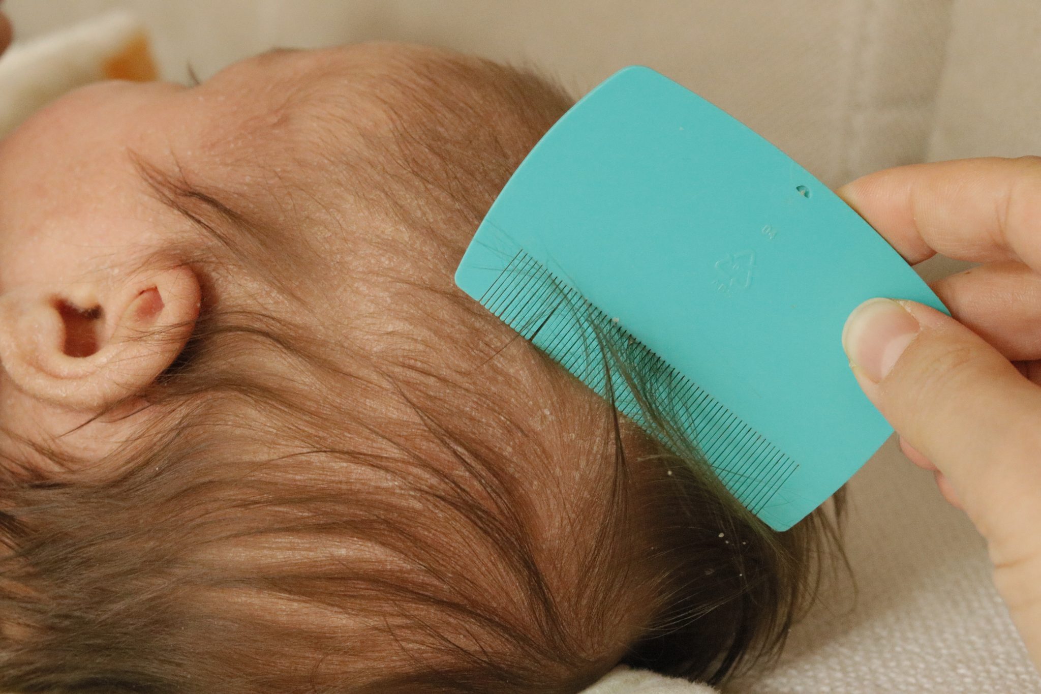 Croûtes de lait chez votre bébé causes, symptômes et traitement
