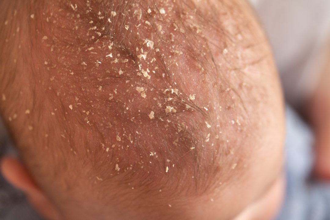 Croûtes de lait chez votre bébé causes, symptômes et traitement