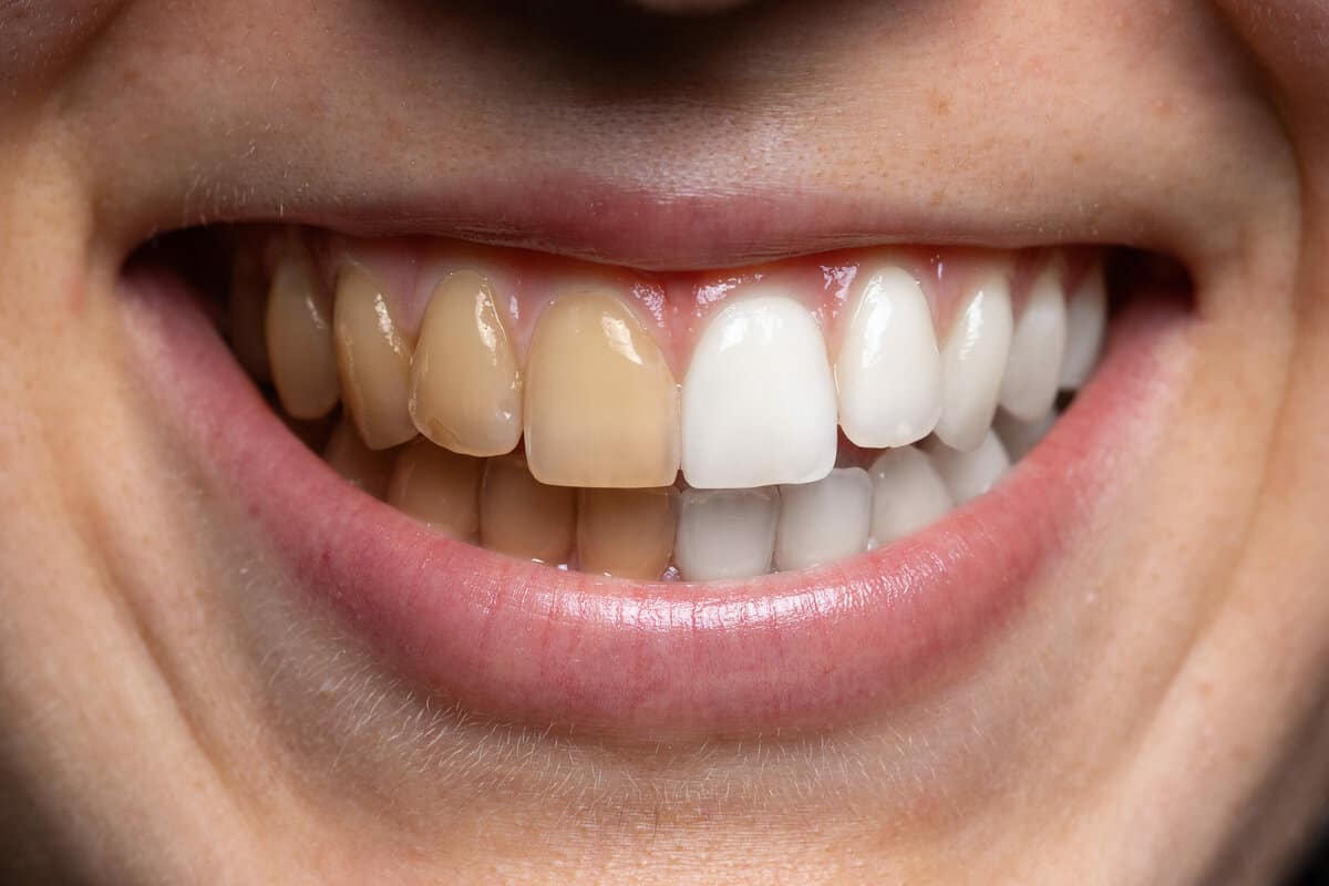 Dents jaunes : causes, solutions et traitements naturels