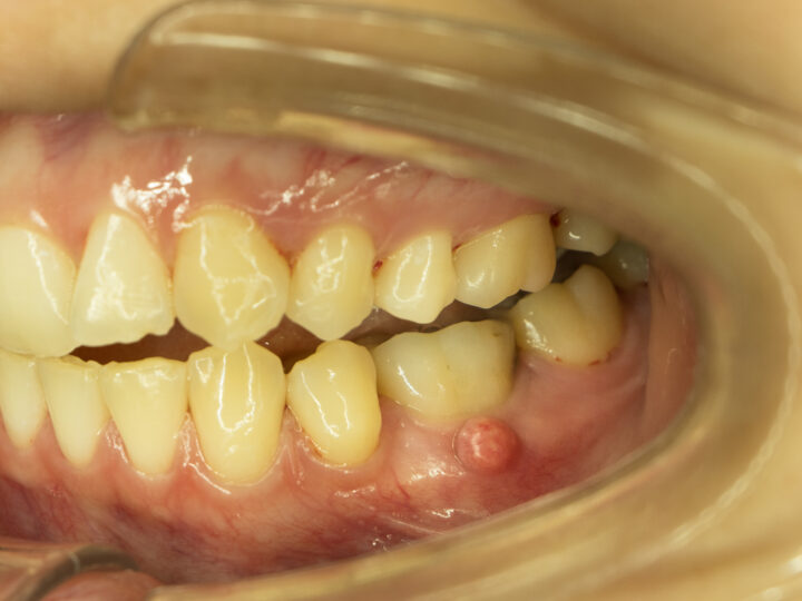 Abcès dentaire : quels sont les causes et les traitements possibles ?