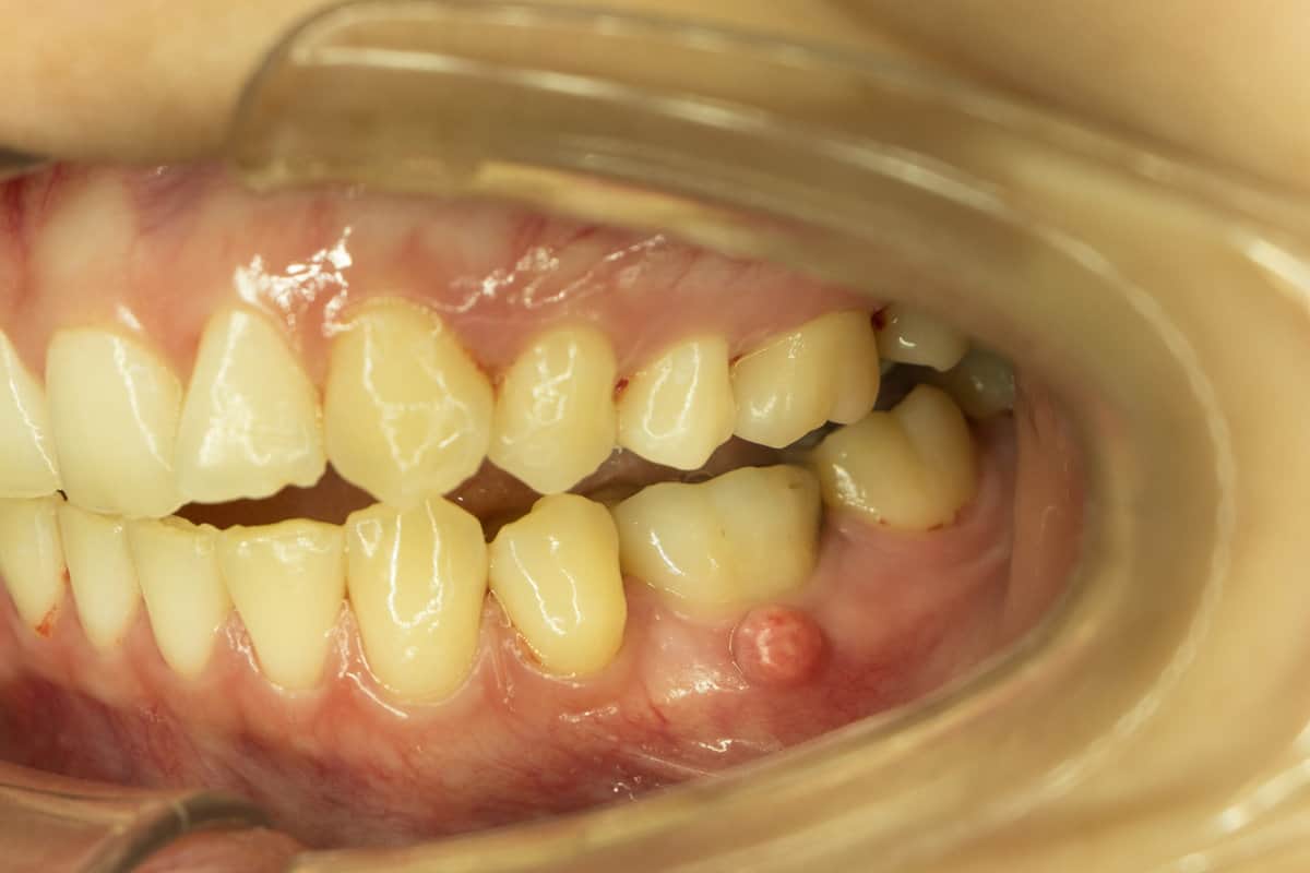 Abcès dentaire : quels sont les causes et les traitements possibles ?