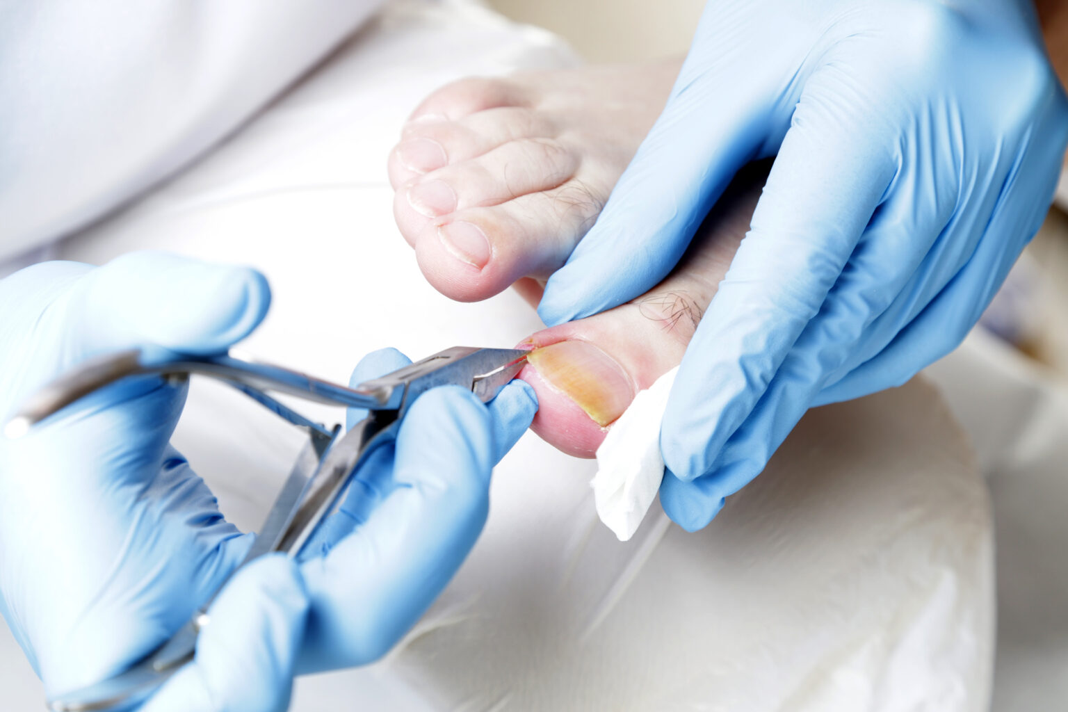 Comment soigner un ongle incarné pour avoir de beaux pieds