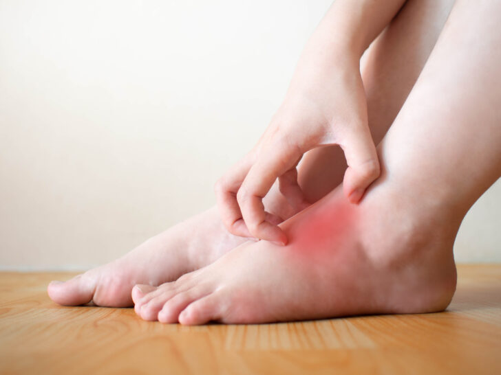 Eczéma au pied : causes, symptômes et traitements efficaces