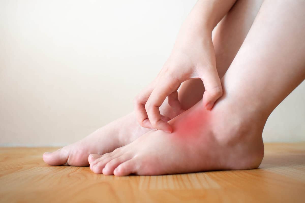 Eczéma au pied : causes, symptômes et traitements efficaces