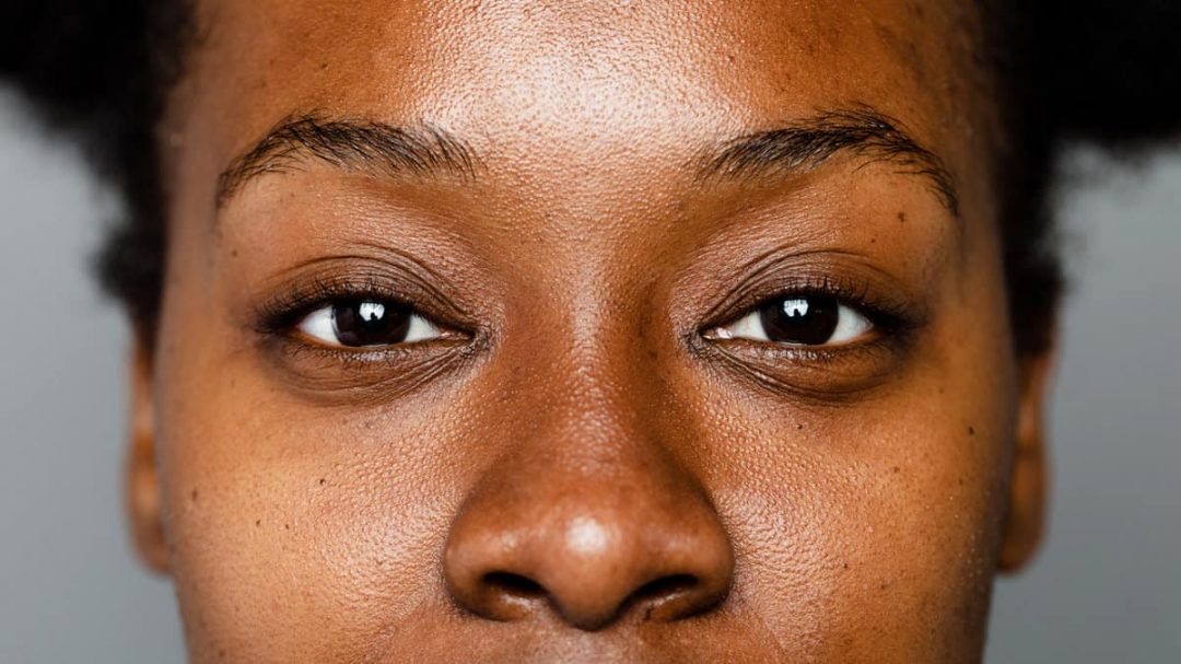 Hyperpigmentation de la peau noire comment s