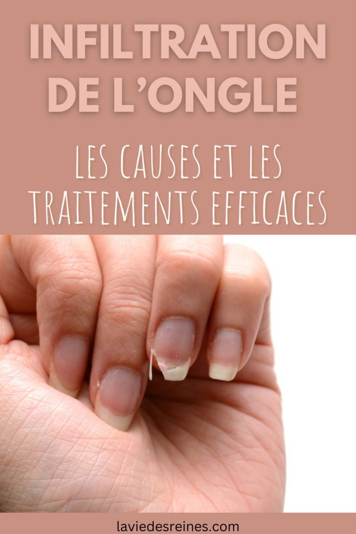 Infiltration de l’ongle les causes et les traitements efficaces — free download